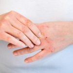 Si të parandalosh lëkurën e thatë ose të plasaritur tek duart?